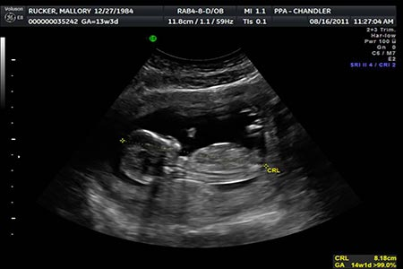 سونوگرافی جنین 13 هفته